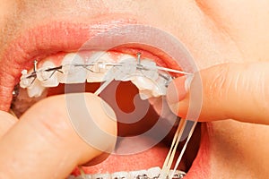 Putting rubber string on braces hooks teeth photo