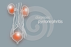Pyelonephritis, aninflammation of the kidney, typically due to a bacterial infection.