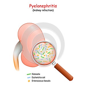Pyelonephritis. kidney infection photo