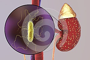 Pyelonephritis, medical concept, and close-up view of bacteria