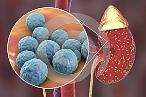 Pyelonephritis, medical concept, and close-up view of bacteria, the common causative agent of kidney infection