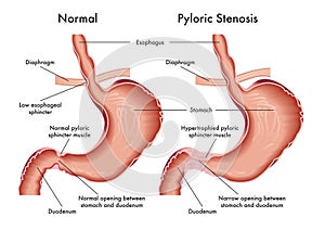 Pyloric Stenosis medical illustration photo