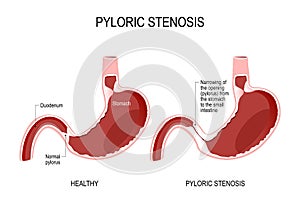 Pyloric stenosis