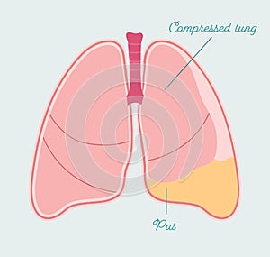 Pyothorax in human lung. Pleural empyema, gathering of pus in pleural space - vector anatomical scheme