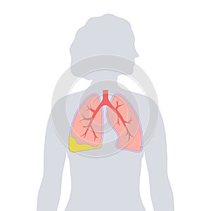 Pyothorax pleural empyema photo