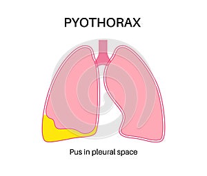 Pyothorax pleural empyema photo