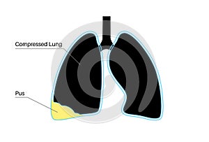 Pyothorax pleural empyema photo