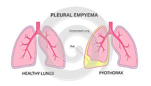 Pyothorax pleural empyema photo