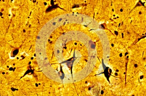 Pyramidal neuron. Neurofibrillary tangles photo