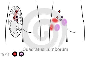 Quadratus lumborum myofascial trigger points can create pain in the hip and buttocks