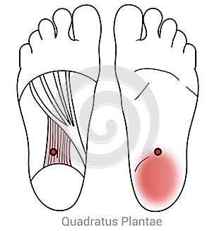 Quadratus plantae myofascial trigger points can cause severe heel pain