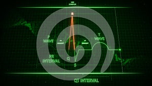 R Wave from Electrocardiogram Wave or ECG or EKG