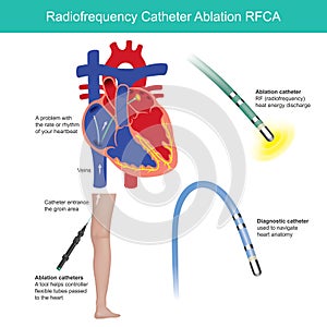 Radio frequency Catheter Ablation. Medical procedure.