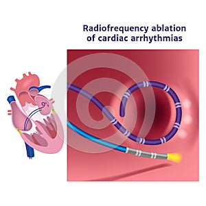 Radiofrequency catheter ablation of the heart.