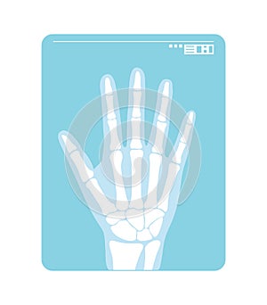 Radiogram of hand. X-ray or roentgenogram. Vector illustration of radiograph photo