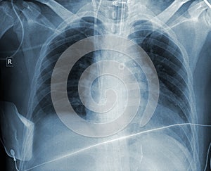 Radiogram result of patient chest