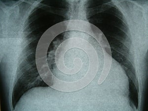 Radiograph, chest, heart failure