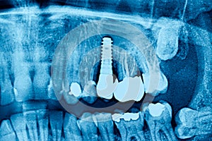 Radiograph dental X-Ray of a Caucasian male with dental implant. Concept of dental implantology