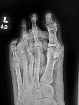 Gangrenous left foot in diabetic patient - soft tissue gas on Xray photo