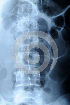 Radiograph of human backbone