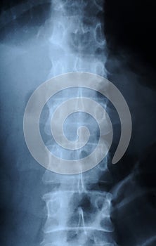 Radiograph of human backbone