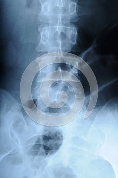 Radiograph of human backbone