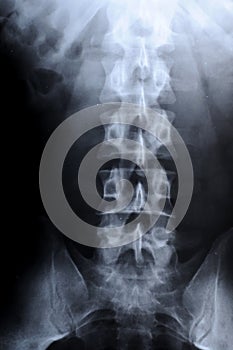 Radiograph of human backbone
