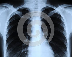 Radiograph of human chest