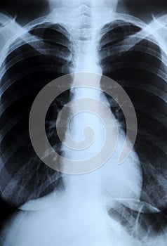 Radiograph of human chest
