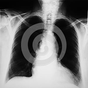 Radiograph of human chest