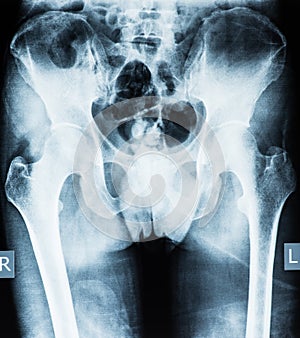 Radiograph of the pelvis