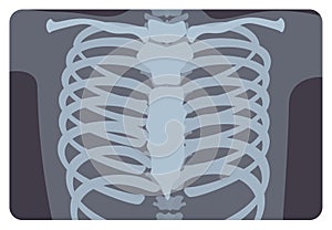 Radiograph, X-radiation picture or X-ray image of rib or thoracic cage formed by vertebral column and sternum. Medical