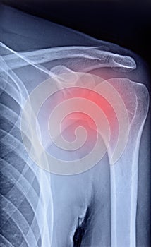 Radiograph of the shoulder photo