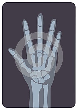 Radiograph, X-radiation picture or X-ray image of hand or palm with wrist and fingers. Modern medical radiography and photo