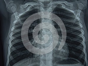 Radiographic image or X-Ray Image of Human Chest for a medical diagnosis . check up concept photo