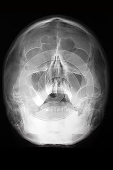 Radiographic view of the skull (head radiologram) photo