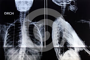 Radiography of back and profile