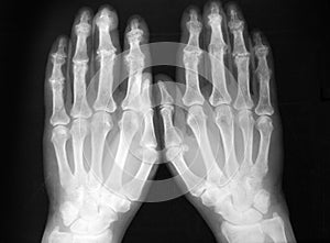 Radiography, of both hands, sever arthritis