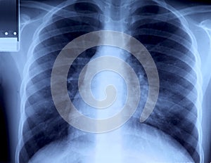 Radiography of chest