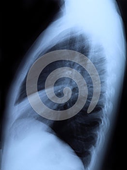 Radiography of chest