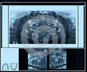 Radiography of children denture