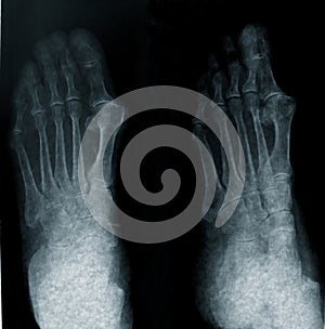 Radiography of foot