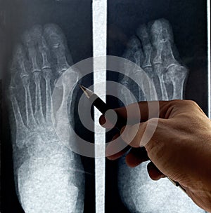 Radiography of foot