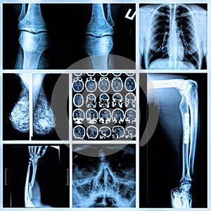 Radiography of Human Bones