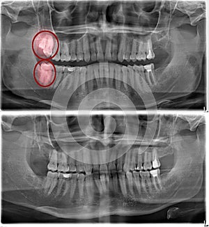 Radiography images before and after the removal of three wisdom teeth