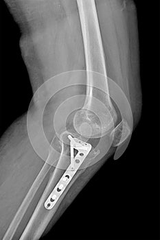 Radiography of the operated Tibia, in a patient after an accident