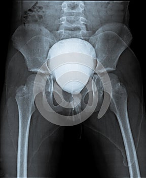 Radiography of pelvis with contrast in bladder.