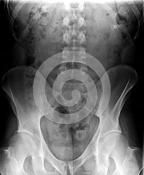 Radiography, x-ray of a vertebral column