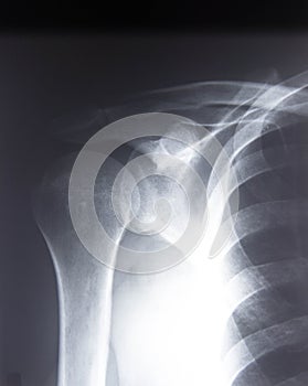 Radiography of the shoulder joint and ribs in direct projection with a fracture of the collarbone