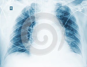 Radiological control of hypostatic pneumonia